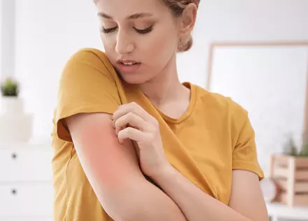 A bőrallergia fajtái, felismerése és kezelése